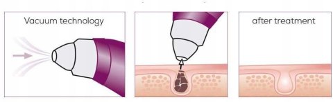 Odkurzacz do wągrów Beurer 3 W Oczyszczanie porów