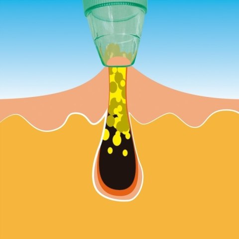 OCZYSZCZACZ PORÓW ZESTAW DO USUWANIA WĄGRÓW WĄGRY
