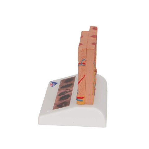 Model raka skóry 3B Scientific J15 różne etapy, 14 cm × 10 cm × 11,43 cm