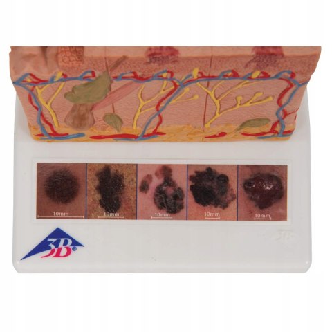 Model raka skóry 3B Scientific J15 różne etapy, 14 cm × 10 cm × 11,43 cm